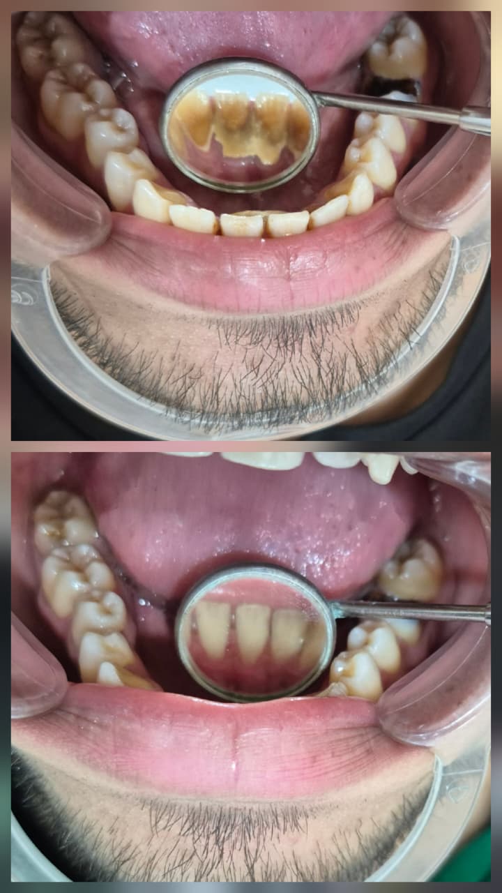 Before and after smile transformation 6
